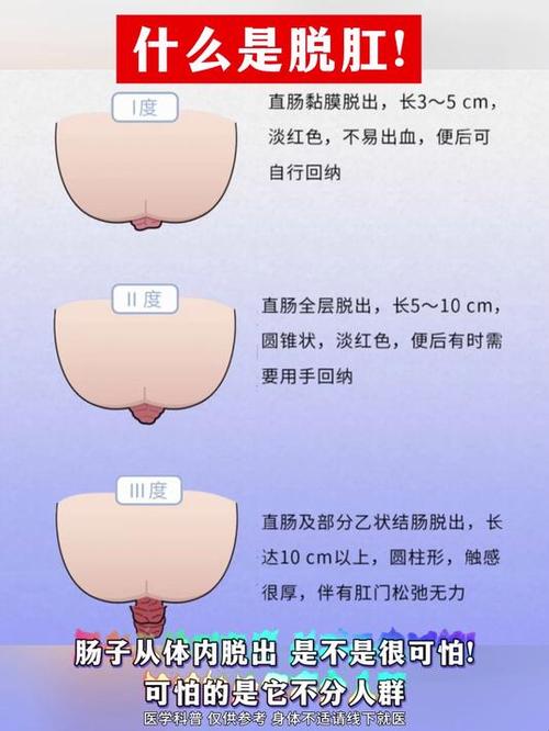 儿童脱肛有哪些典型症状？不同年龄段治疗方式有何差异？-第1张图片-郑州医学网