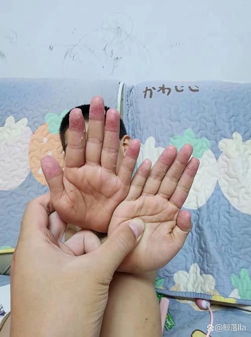 新生儿手脱皮到底该擦什么？日常护理与用药选择指南-第2张图片-郑州医学网