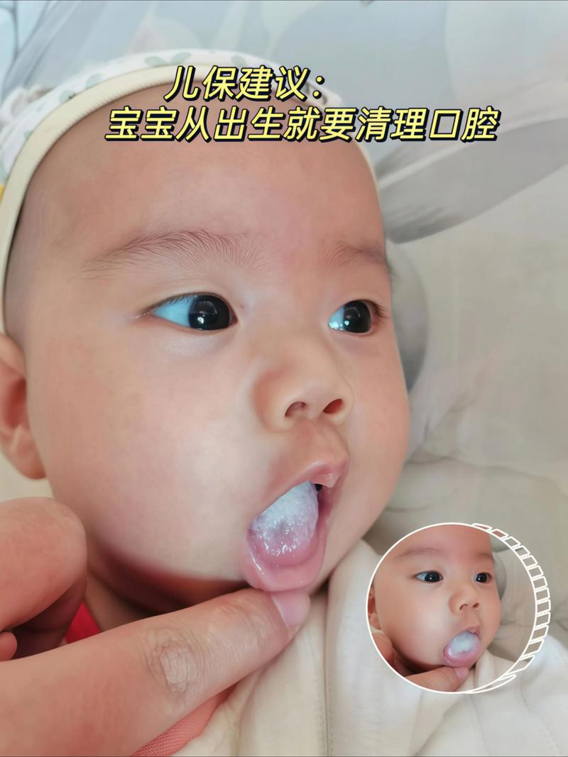 新生儿白色舌苔怎么办-第1张图片-郑州医学网