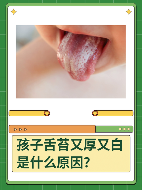 新生儿白色舌苔怎么办-第3张图片-郑州医学网