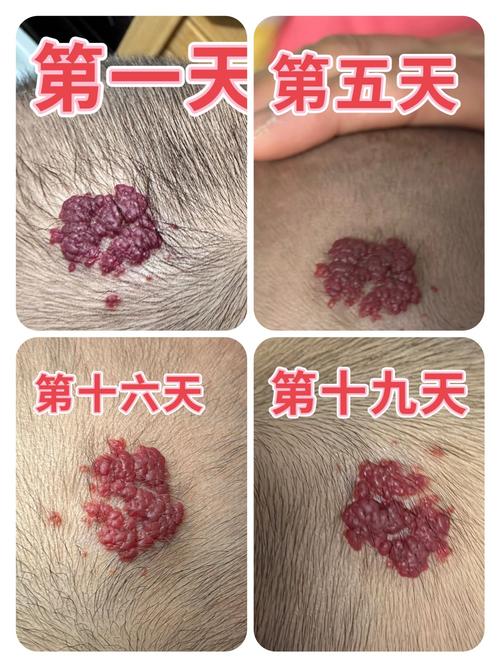 新生儿血管瘤治疗时间越早越好吗？最佳干预时机是什么时候？-第2张图片-郑州医学网