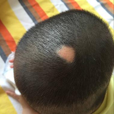 新生儿头皮出现无发区域是何原因？是否需要担心或就医干预？-第2张图片-郑州医学网