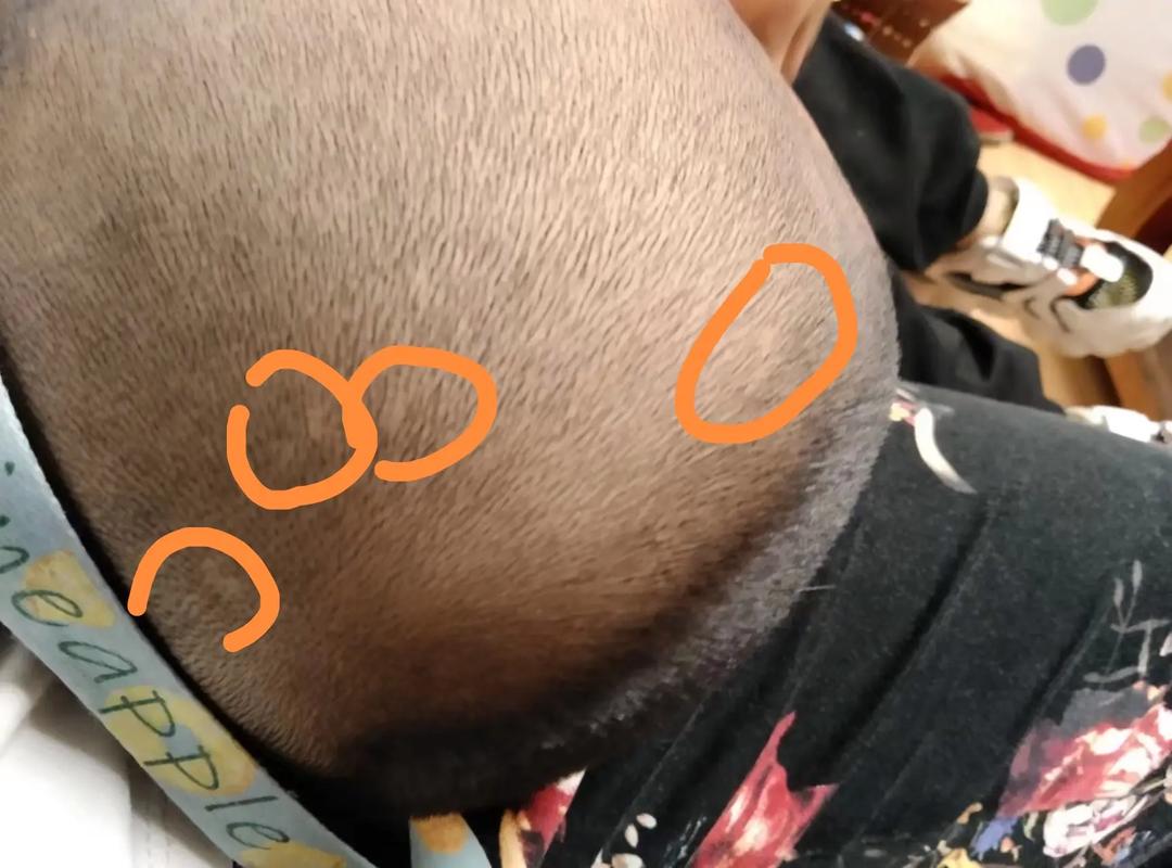 新生儿头皮出现无发区域是何原因？是否需要担心或就医干预？-第3张图片-郑州医学网