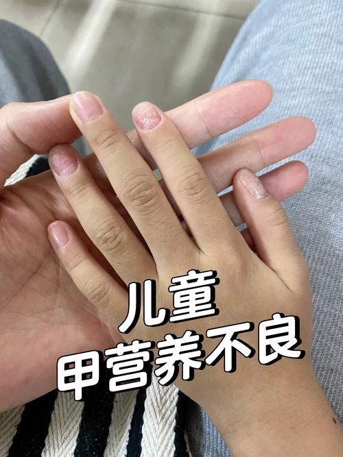 新生儿甲减症状有哪些？早期识别关键指标与异常表现有哪些？-第2张图片-郑州医学网