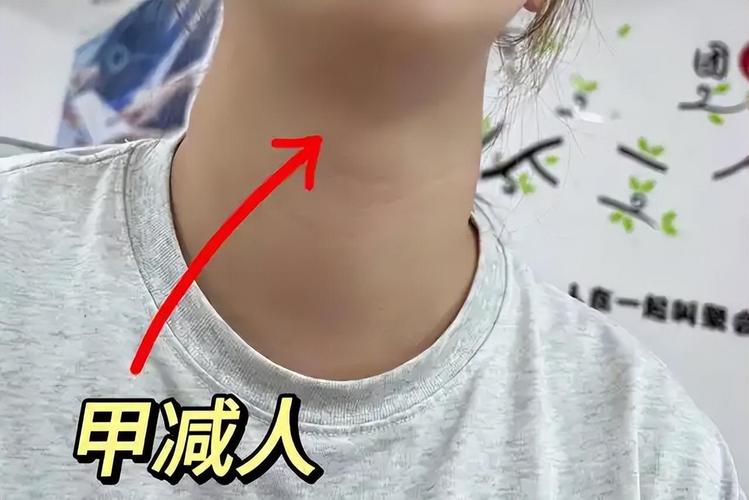 新生儿甲减症状有哪些？早期识别关键指标与异常表现有哪些？-第3张图片-郑州医学网