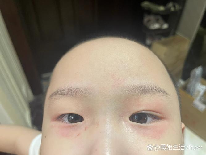 儿童眼睛周围出现红血点，是过敏还是疾病信号？需警惕哪些潜在风险？-第1张图片-郑州医学网