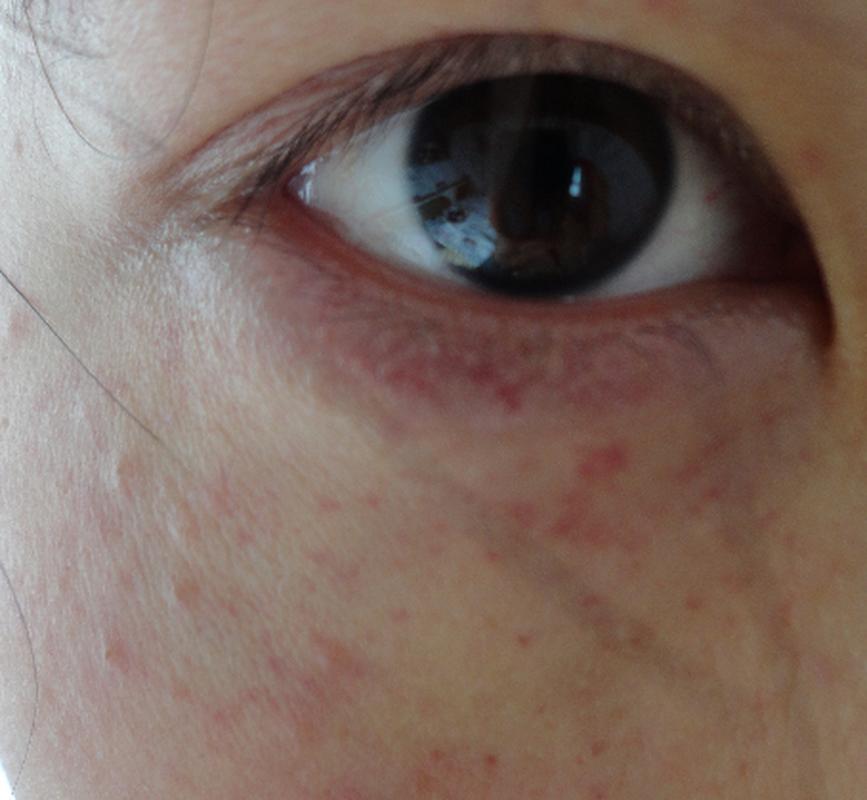 儿童眼睛周围出现红血点，是过敏还是疾病信号？需警惕哪些潜在风险？-第2张图片-郑州医学网