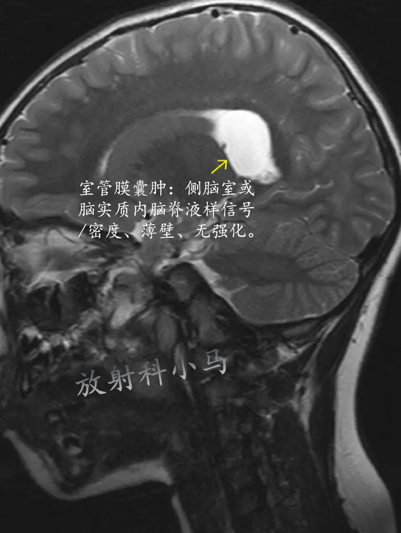 新生儿右侧室管膜囊肿需要治疗吗？会影响发育吗？-第1张图片-郑州医学网