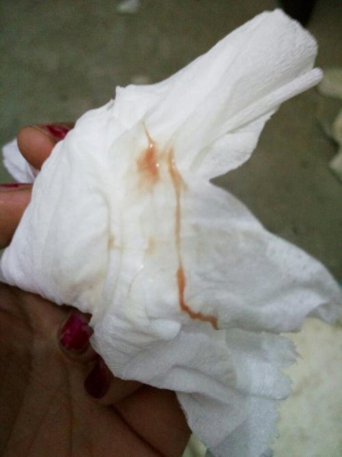 孕期28周白带有血丝是早产征兆吗？需要立即就医检查吗？-第3张图片-郑州医学网