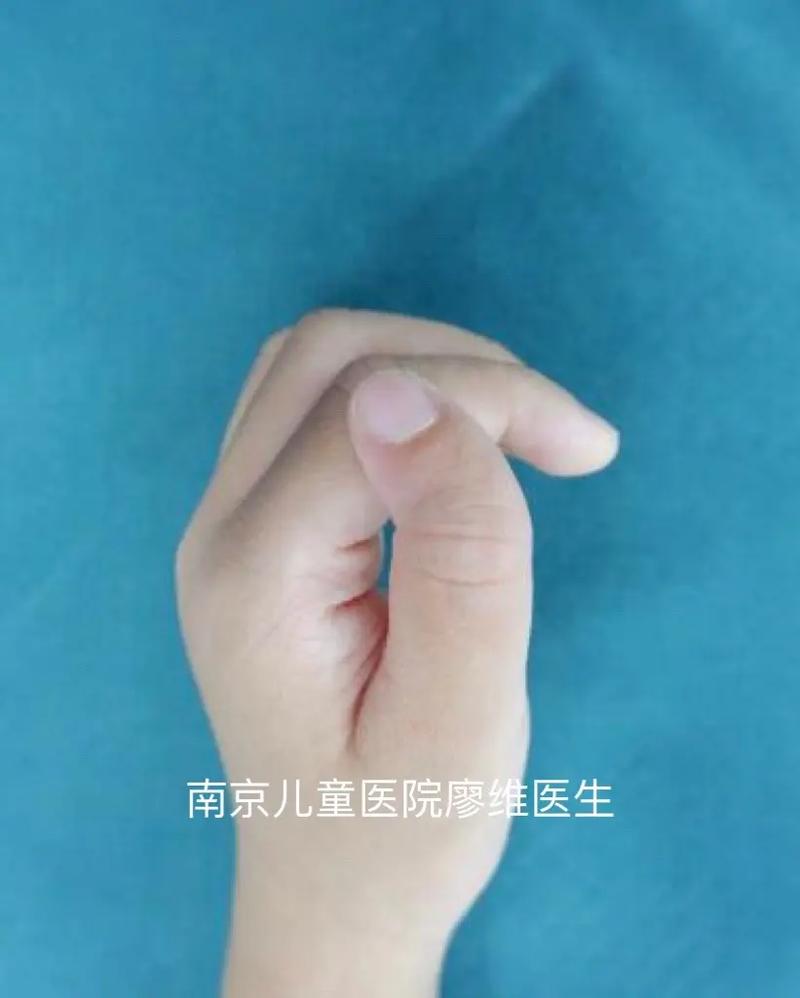 儿童拇指弯曲不能伸直，是先天畸形还是后天损伤？该如何处理？-第2张图片-郑州医学网