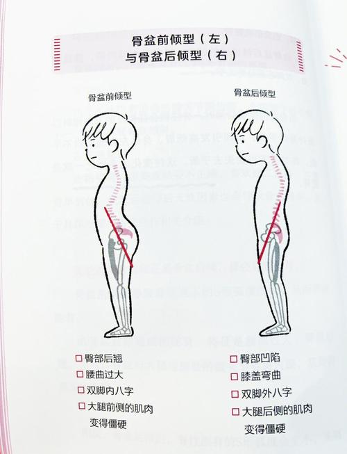儿童含胸驼背矫正方法有哪些？不同年龄段矫正方案有何差异？-第1张图片-郑州医学网