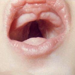 孕期情绪波动是否真的会导致胎儿兔唇？科学依据在哪里？-第1张图片-郑州医学网