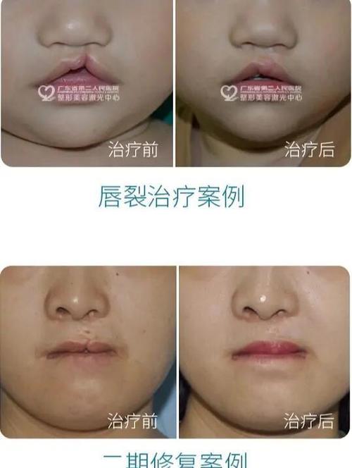 孕期情绪波动是否真的会导致胎儿兔唇？科学依据在哪里？-第2张图片-郑州医学网