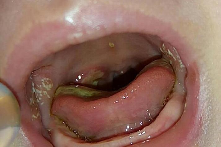 儿童新牙长出白色斑点是缺钙还是牙釉质发育问题？需警惕哪些潜在风险？-第3张图片-郑州医学网