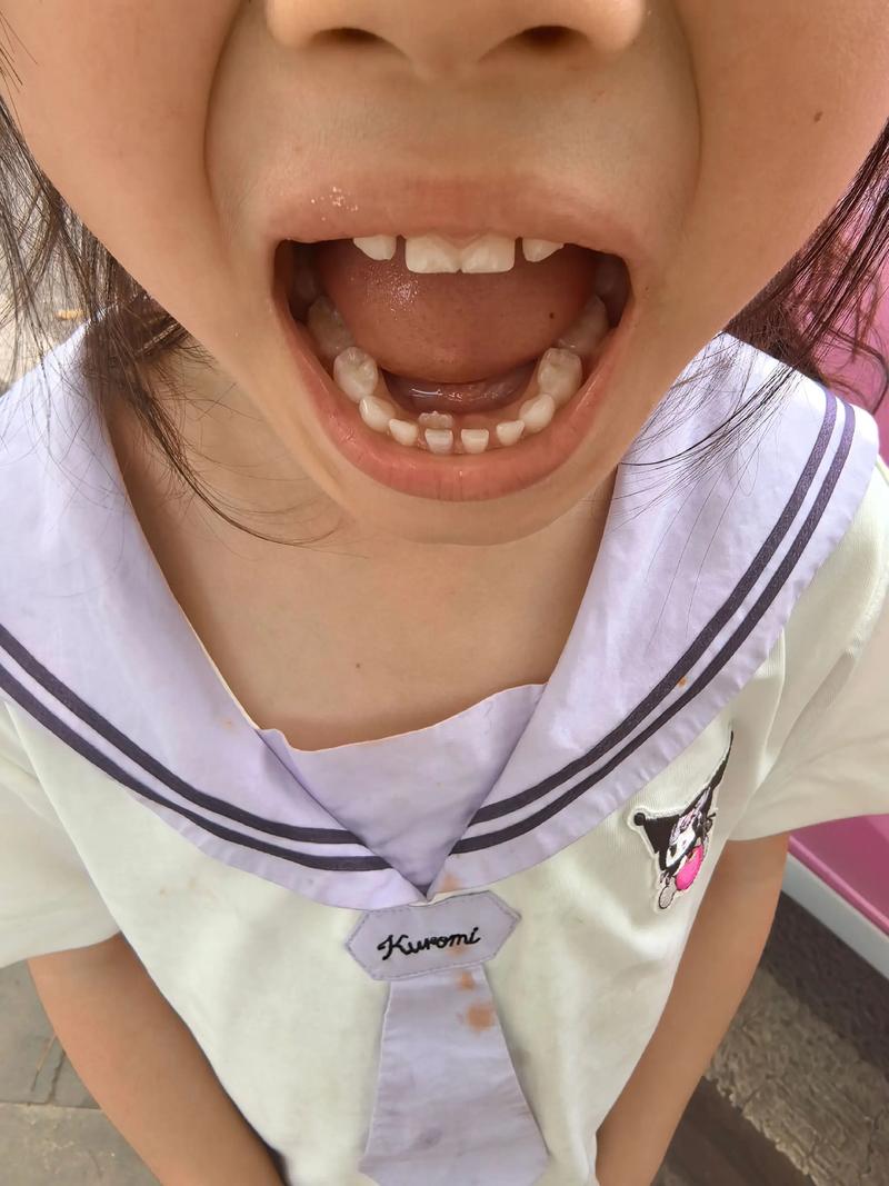 儿童自己在家拔牙如何才能做到真正不痛且安全？-第1张图片-郑州医学网