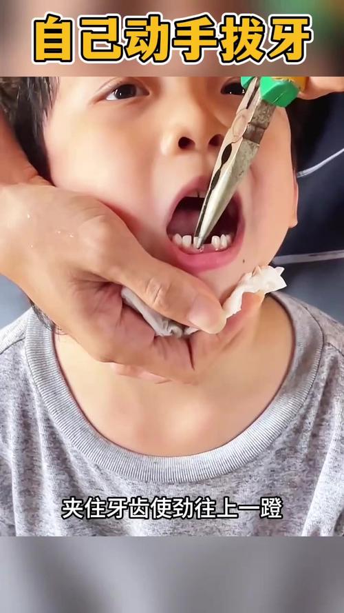 儿童自己在家拔牙如何才能做到真正不痛且安全？-第2张图片-郑州医学网