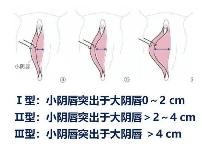 儿童外阴正常图片对照，这些特征需注意哪些异常信号？-第3张图片-郑州医学网
