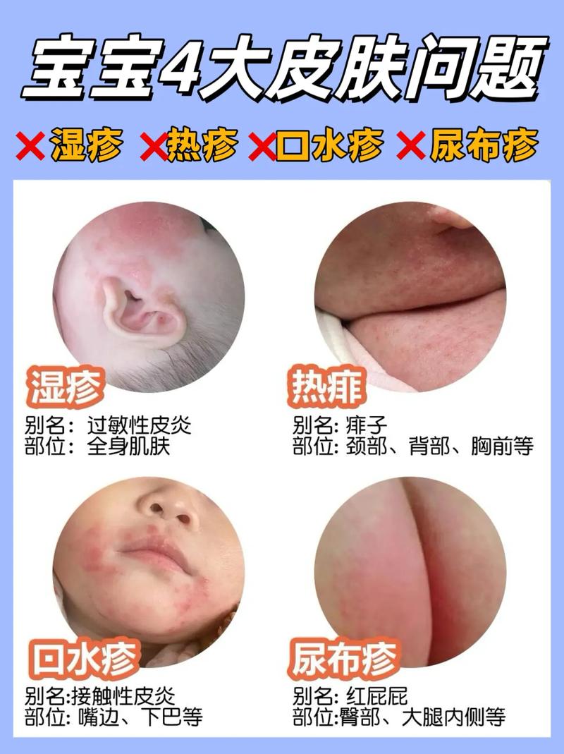新生儿脸上湿疹反复发作，究竟是什么原因在作祟？-第3张图片-郑州医学网