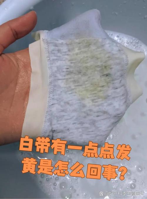 孕期水样白带干后发黄是感染信号吗？需警惕哪些异常情况？-第2张图片-郑州医学网