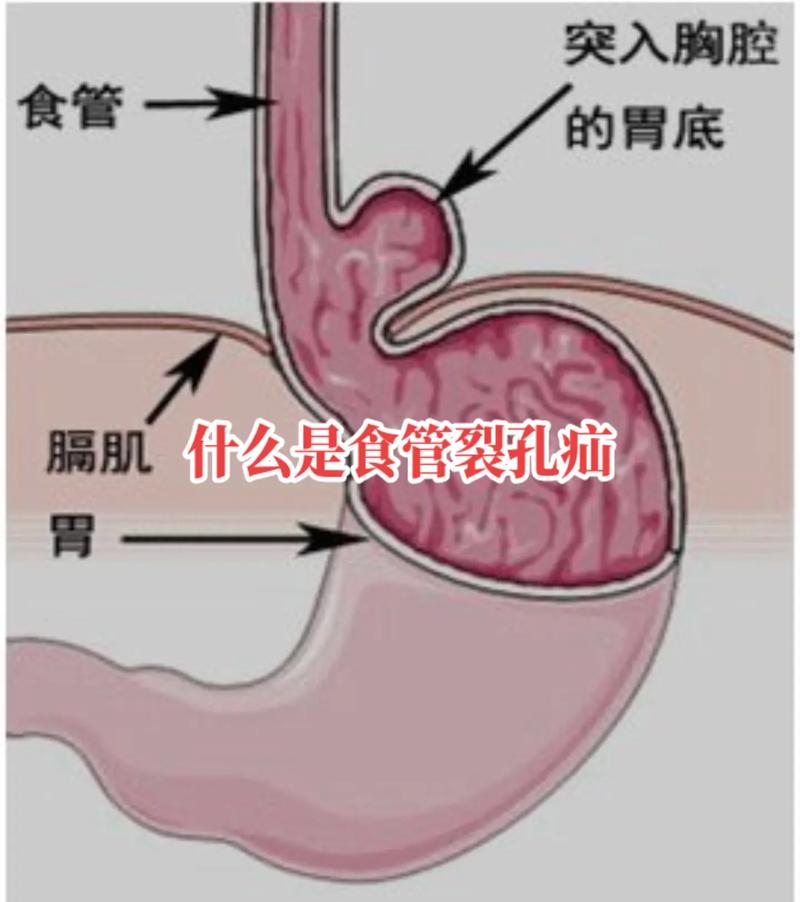 新生儿食道狭窄会出现哪些典型症状?家长又该如何早期识别与应对?-第3张图片-郑州医学网 新生儿食道狭窄会出现哪些典型症状?家长又该如何早期识别与应对?-第3张图片-郑州医学网