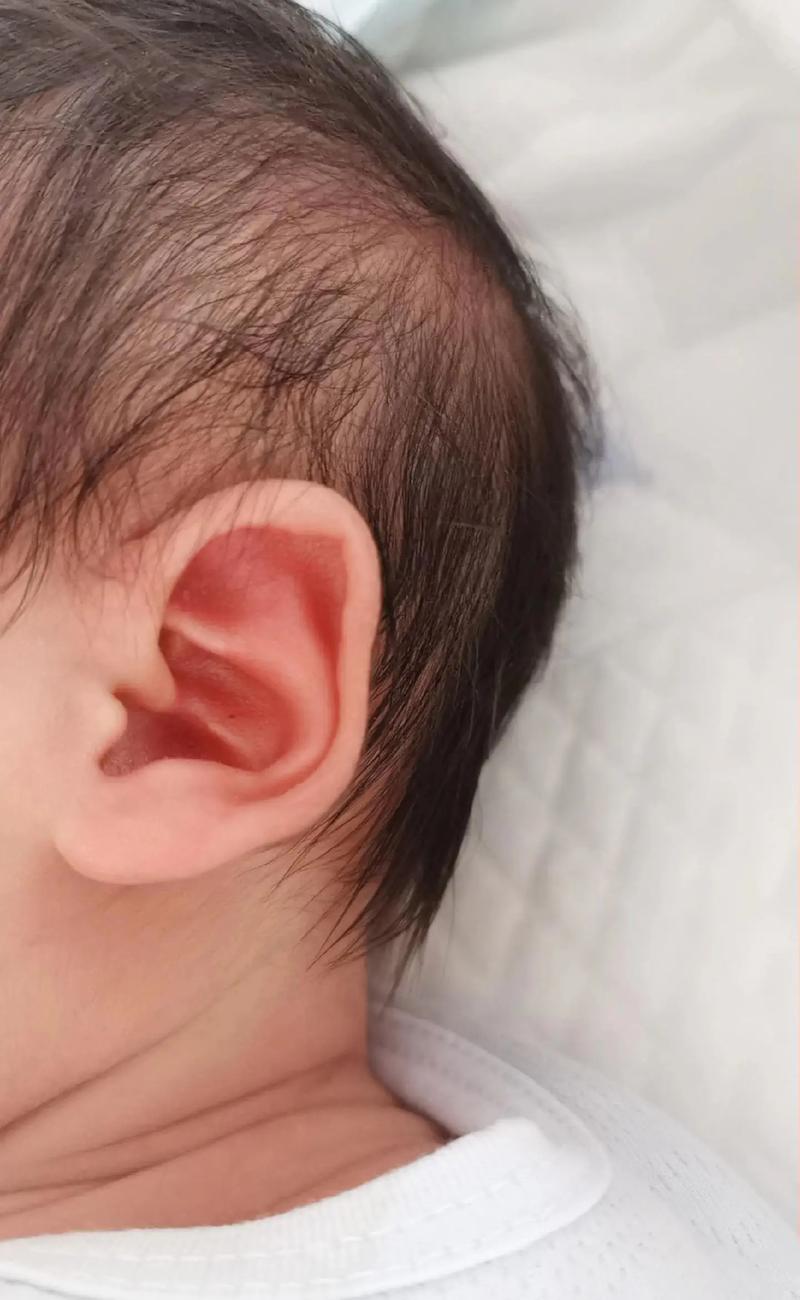 新生儿耳朵上有小耳朵-第1张图片-郑州医学网 新生儿耳朵上有小耳朵-第1张图片-郑州医学网