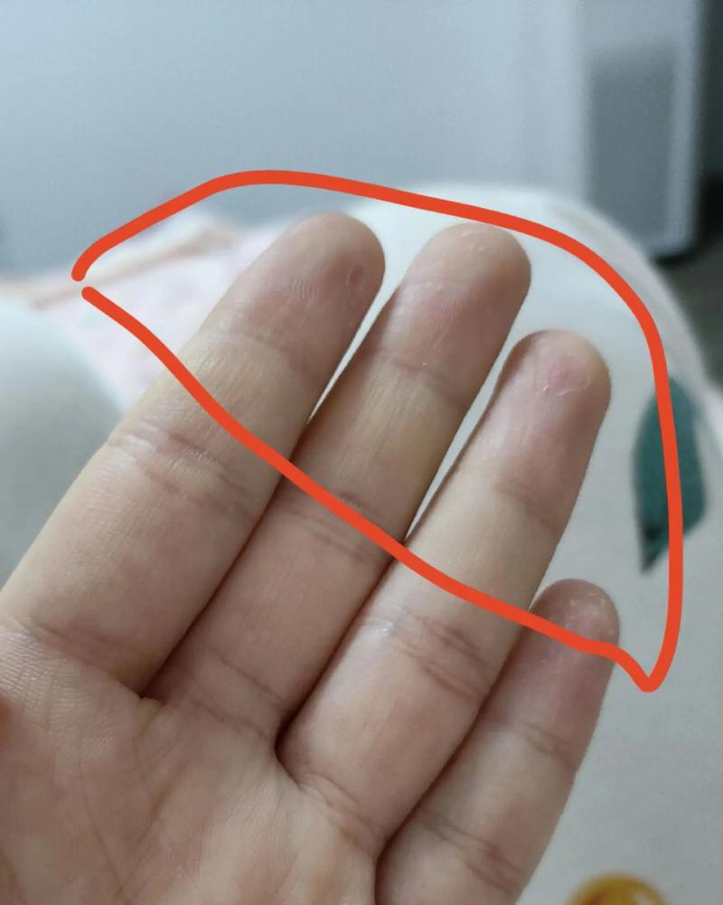 孕期手指麻木，产后为何仍不缓解？原因与应对方法是什么？-第2张图片-郑州医学网