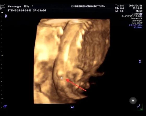 孕期大排畸脊柱没看清-第2张图片-郑州医学网