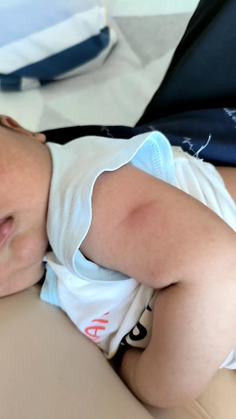 新生儿卡介苗接种后化脓破溃了，这正常吗？需要如何护理？-第3张图片-郑州医学网