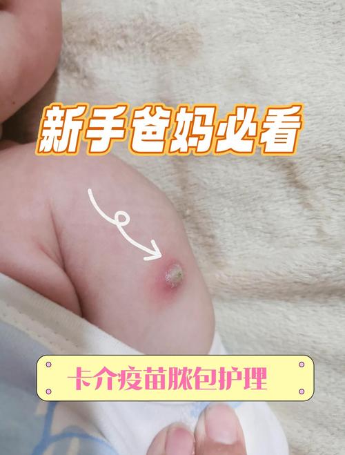 新生儿卡介苗接种后化脓破溃了，这正常吗？需要如何护理？-第2张图片-郑州医学网
