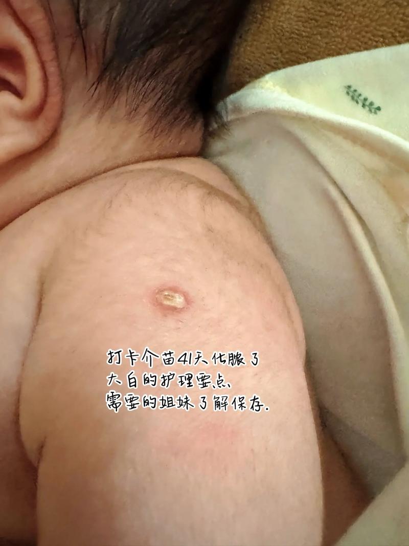 新生儿卡介苗接种后化脓破溃了，这正常吗？需要如何护理？-第1张图片-郑州医学网