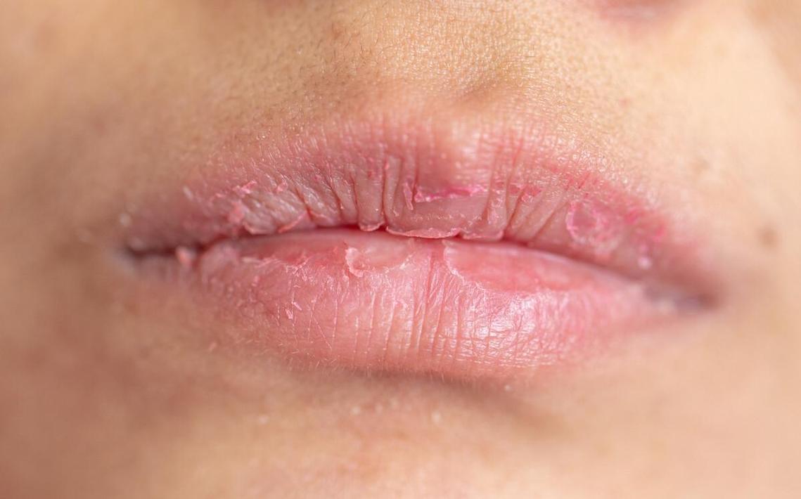 儿童嘴唇干裂脱皮是什么原因导致的?如何正确护理和治疗?-第2张图片-郑州医学网 儿童嘴唇干裂脱皮是什么原因导致的?如何正确护理和治疗?-第2张图片-郑州医学网