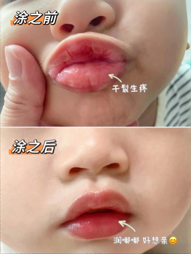 儿童嘴唇干裂脱皮是什么原因导致的?如何正确护理和治疗?-第3张图片-郑州医学网 儿童嘴唇干裂脱皮是什么原因导致的?如何正确护理和治疗?-第3张图片-郑州医学网