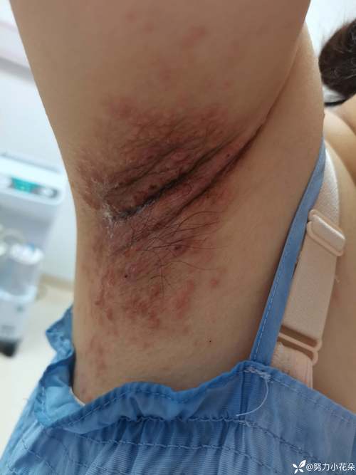 孕期感染单纯疱疹病毒-第1张图片-郑州医学网 孕期感染单纯疱疹病毒-第1张图片-郑州医学网