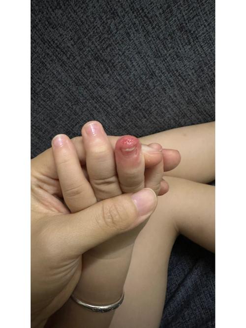 儿童手指干燥开裂图片-第1张图片-郑州医学网