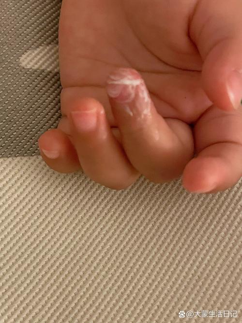 儿童手指干燥开裂图片-第2张图片-郑州医学网