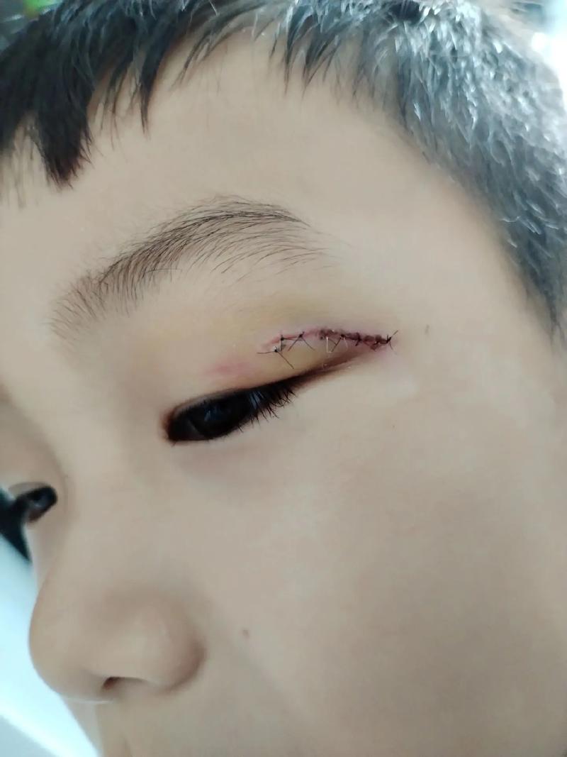 儿童脸部摔伤肌肉断裂-第2张图片-郑州医学网