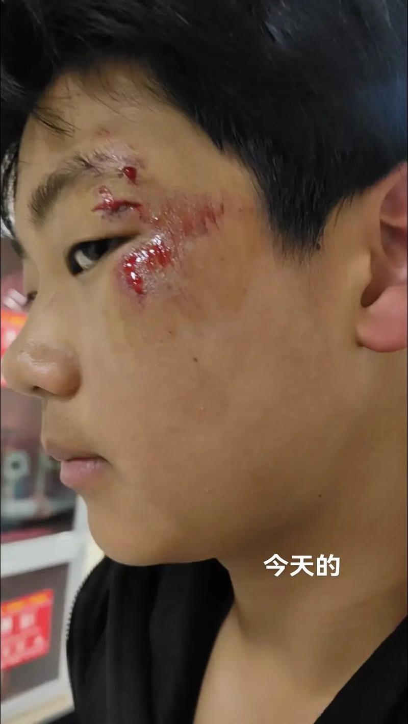 儿童脸部摔伤肌肉断裂-第1张图片-郑州医学网