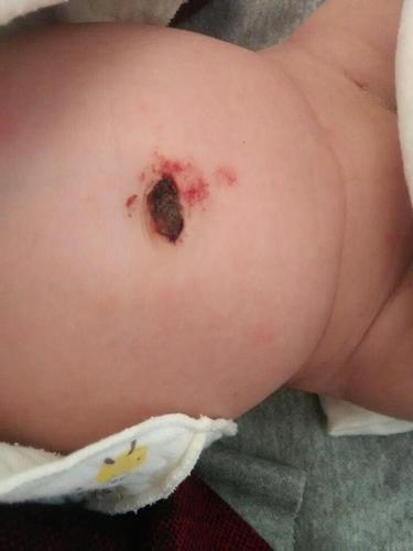 新生儿肚脐带根部有血丝是感染还是脱落异常？需如何护理处理？-第2张图片-郑州医学网