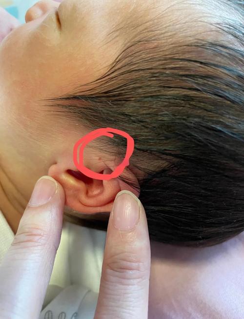 新生儿耳朵发黑是正常现象吗？需要担心健康问题吗？-第2张图片-郑州医学网