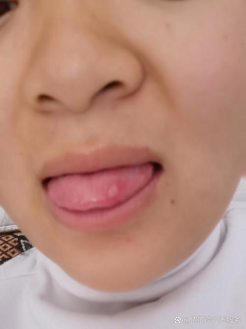 孕期舌头起泡是上火还是疾病信号?需警惕哪些孕期口腔问题?-第2张图片-郑州医学网 孕期舌头起泡是上火还是疾病信号?需警惕哪些孕期口腔问题?-第2张图片-郑州医学网