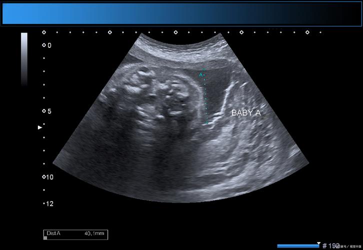 新生儿双肾实质回声增强是异常信号吗?需警惕哪些疾病风险?-第2张图片-郑州医学网 新生儿双肾实质回声增强是异常信号吗?需警惕哪些疾病风险?-第2张图片-郑州医学网