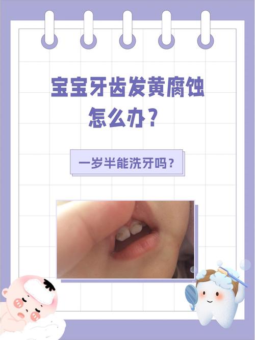 儿童牙齿发黄怎么去除-第3张图片-郑州医学网