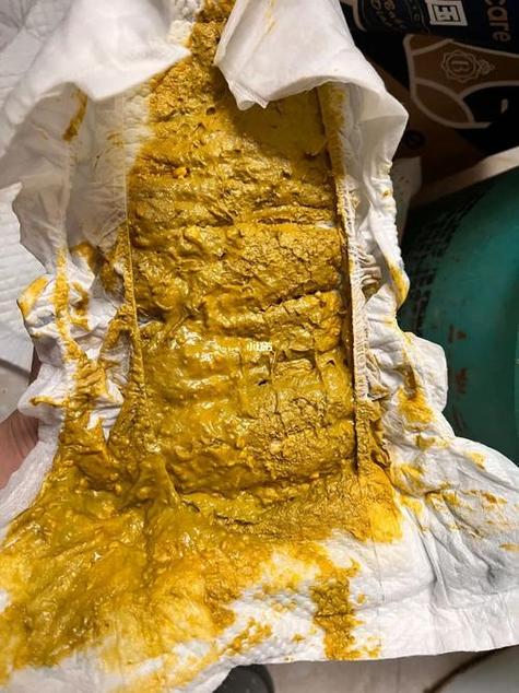 正常母乳新生儿大便图-第3张图片-郑州医学网