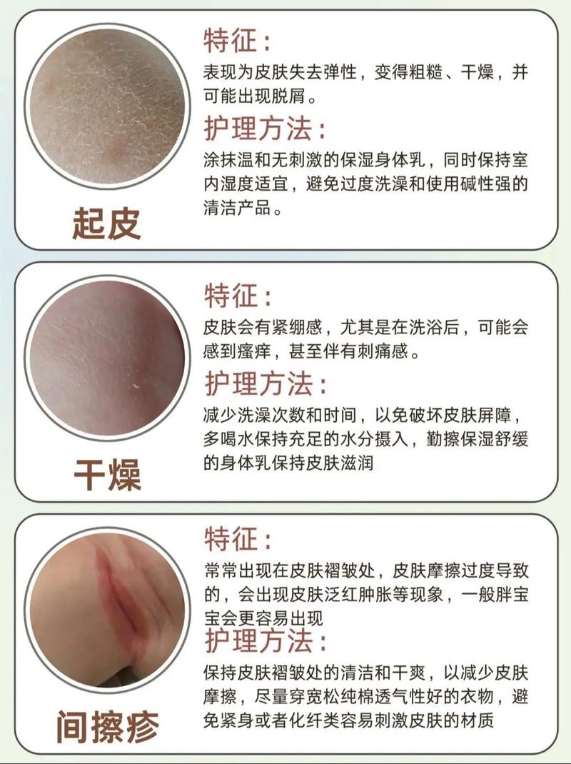 儿童特异性皮炎反反复复，到底该怎么治才能好得快还不复发？-第2张图片-郑州医学网