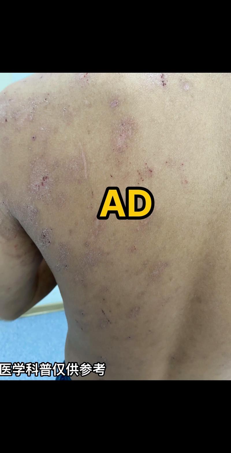 儿童特异性皮炎反反复复，到底该怎么治才能好得快还不复发？-第1张图片-郑州医学网