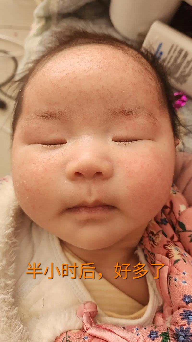 儿童特异性皮炎反反复复，到底该怎么治才能好得快还不复发？-第3张图片-郑州医学网