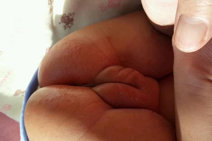 新生儿肛门周围红破皮-第1张图片-郑州医学网