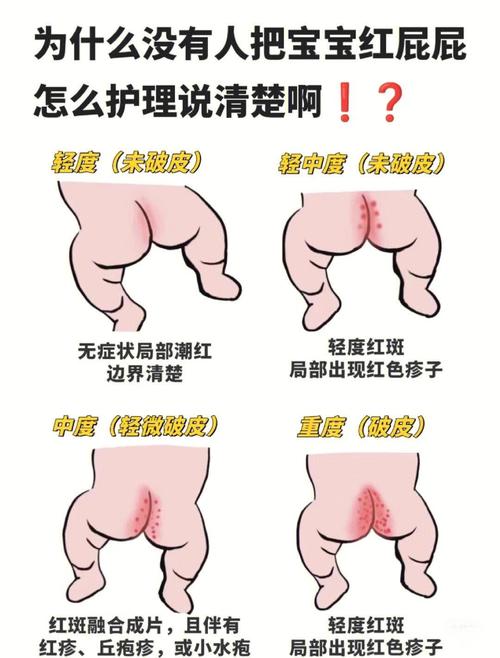 新生儿肛门周围红破皮-第2张图片-郑州医学网