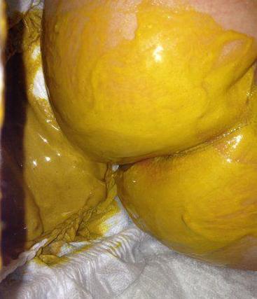 新生儿拉屎放屁时总是很用力，是正常现象还是身体不舒服？-第2张图片-郑州医学网