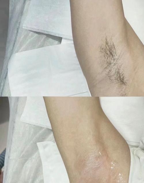 备孕期激光脱毛会影响胎儿健康吗？安全吗？-第2张图片-郑州医学网